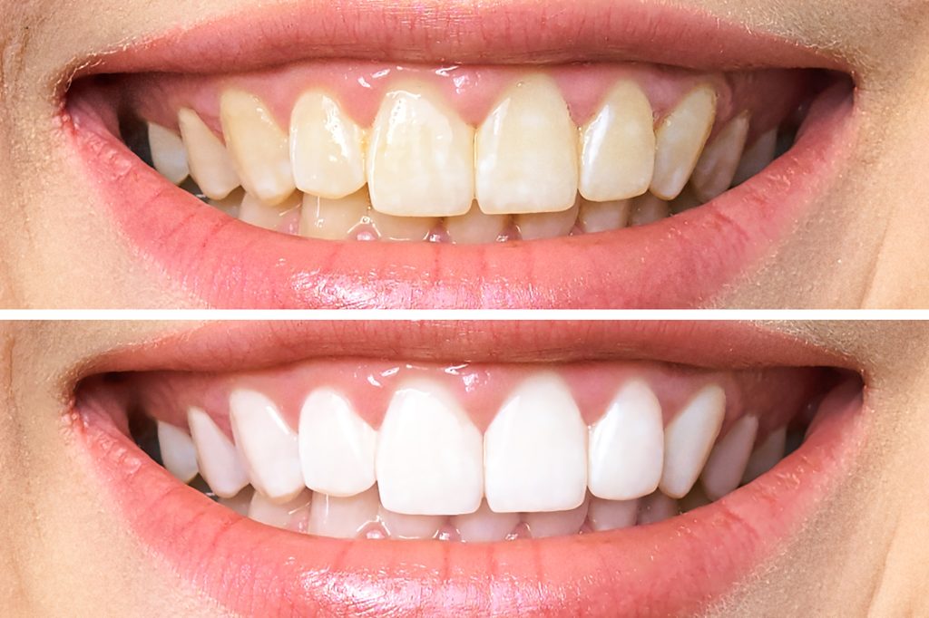 teeth whitening boyd tx